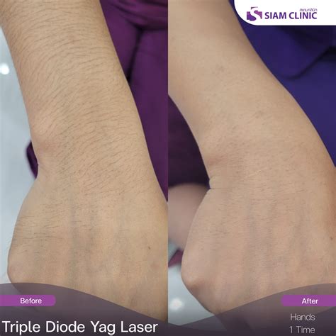 Hair Removal Laser Before and After Photos - Siam Clinic Thailand