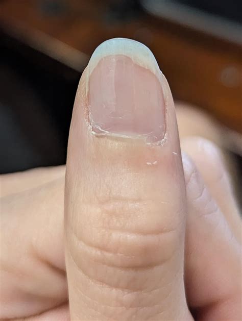 Does this look like fungus? For the past year or so, the white part of my nail has been looking ...