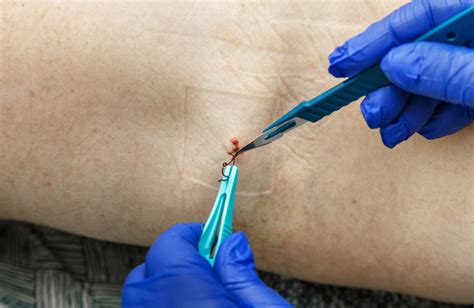 Are Blue Stitches Dissolvable?-Surgical Suture Manufacturer
