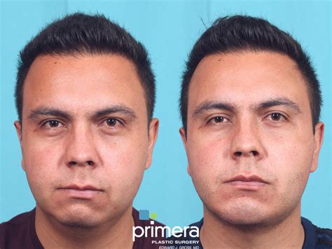 Is Buccal Fat Removal the Answer to Your ‘Chubby Cheeks?’ – Primera Plastic Surgery