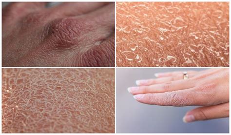 Xerodermatitis Atopic Dermatitis In Children And Adults: How To Help