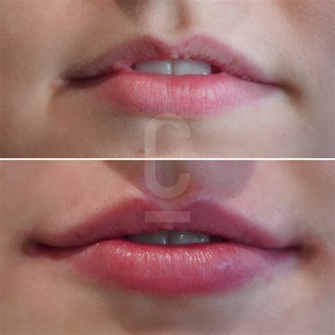 Understanding 1ml Lip Filler Impact - Cosmetic Connection