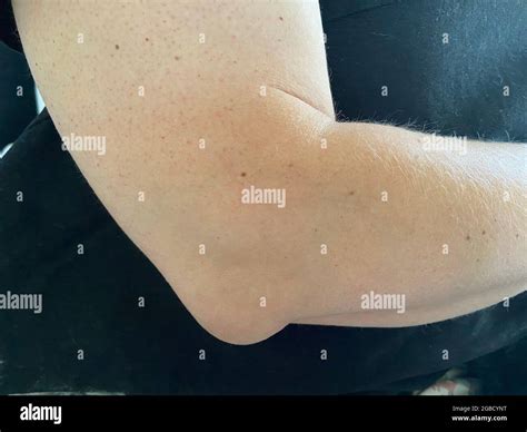 What Causes Fluid Sac On The Elbow at Malik Keck blog