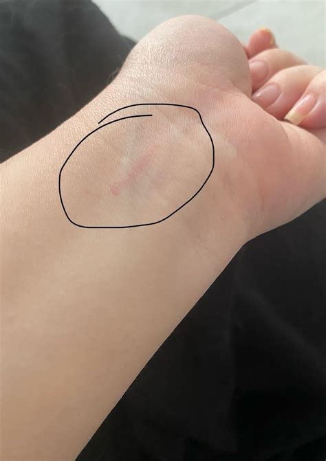Been getting tiny flat red spots on arms now today I woke up with a red line on my wrist, what ...