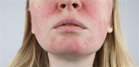 Eczema facial: causas, tratamientos y cuidados