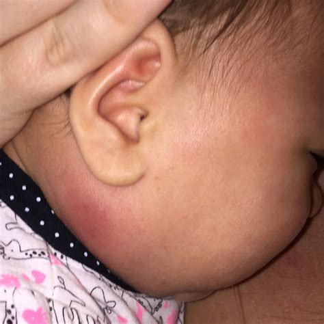 Lump On Neck Behind Ear