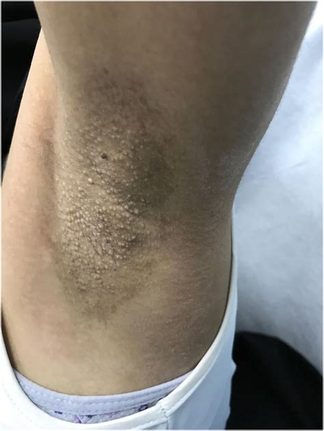 Fox-fordyce disease: Pulsed dye laser versus fractional Co2 laser treatment - JAAD Case Reports