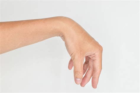 Radial nerve injury or wrist drop | Premium Photo