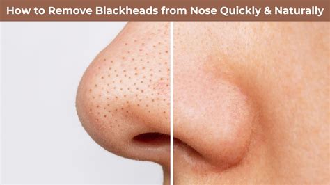 Removing Blackheads On Nose Hilary Rhoda Deep Cleanse Nose Strips