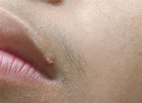 Small Wart on Lip : r/Warts