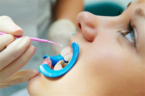 Dental Sealants Waltham, MA - Children's Dental of Waltham