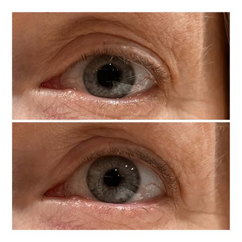 Eye Lift Wand – Topical Eye Lift Treatment Serum | SBLA Beauty