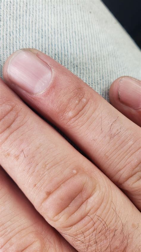 bumps on fingers? any ideas? : r/DermatologyQuestions