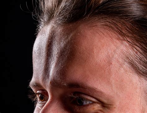 Morphoea en coup de sabre