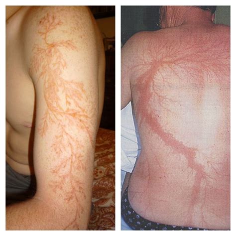 Cool Lightning Scars at Albert Avila blog