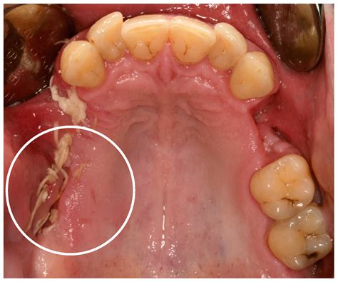 Mountain Dew Mouth Syndrome