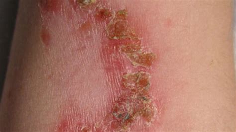 Was ist eigentlich Impetigo contagiosa?