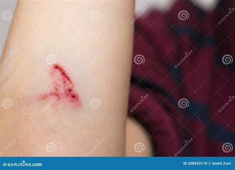 Abrasion Or Scratch at James Goldsbrough blog