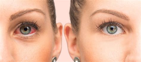 Pink Eye vs Dry Eye: What’s the Difference? - CorneaCare