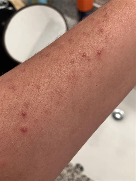 Red bumps on arms every summer : r/DermatologyQuestions