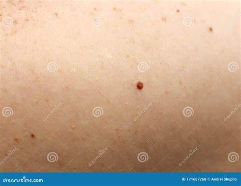 Mole Vs Freckle Pictures at Ellen Hannan blog