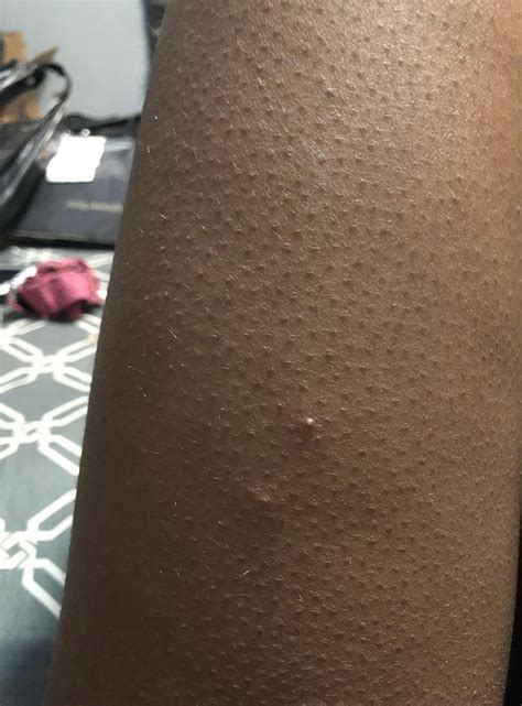 [Acne] sudden red raised bumps on thigh : r/SkincareAddiction