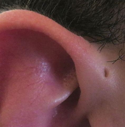 Humans With Vestigial Gills