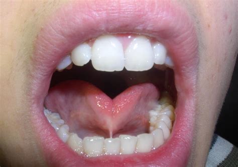 Labial Frenulum Laceration