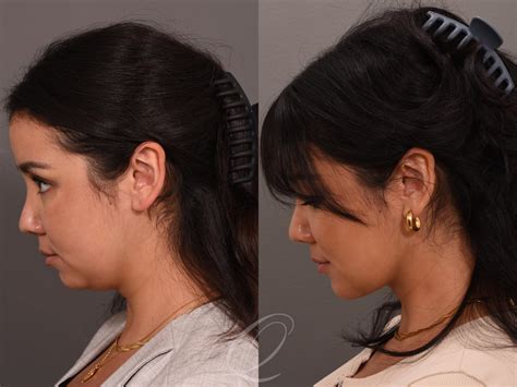 Deep Neck Contouring Before & After Photos Patient 1001548 | Serving Rochester, Syracuse ...