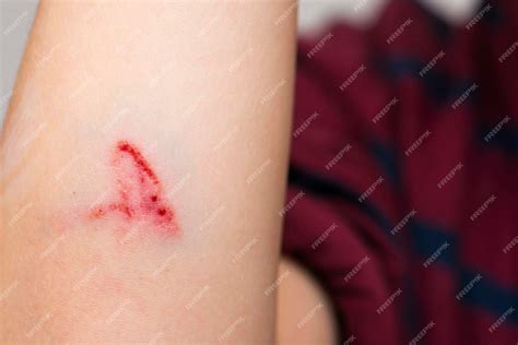 Premium Photo | Deep scratches on the skin with bruises on the childs hand