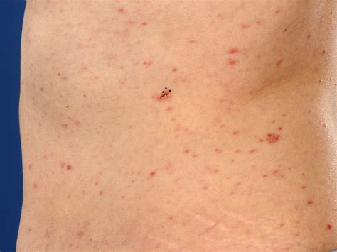 Pityriasis lichenoides chronica et acuta