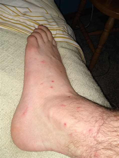 Seed Treatment For Tick Bites