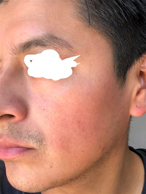 Rash that won't go away 😞 : r/DermatologyQuestions