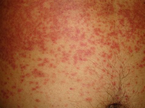 Fever and Rash - Dermatology Advisor