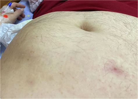 Man with an Abdominal Mass - Annals of Emergency Medicine