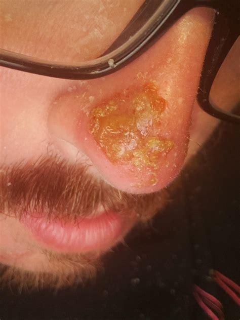 Sunburn on nose, blistered and within a day looks like this. What to put on it? What is it? : r ...