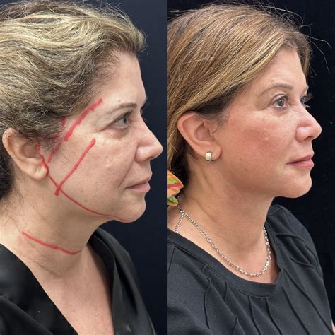 Facial Fat Transfer Before & After Photos | Mansher Singh, MD