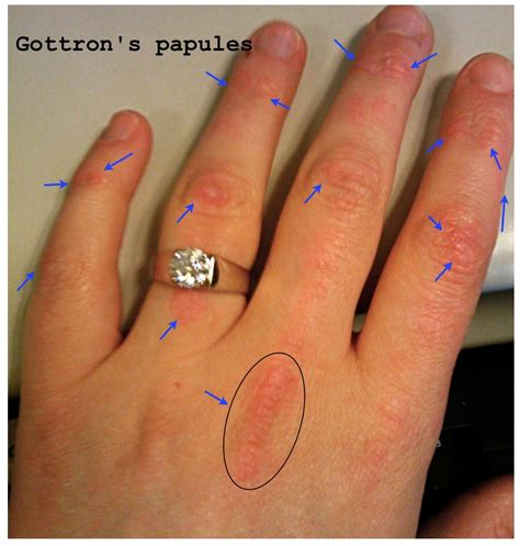 Why Do I Have Small Bumps On My Hands That Hurt at Kristy Breeden blog