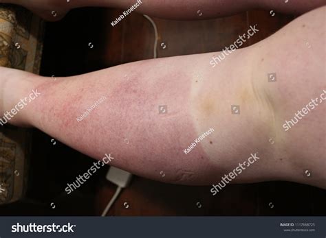 Legs And Feet Swollen From Sunburn at Bruce Macias blog