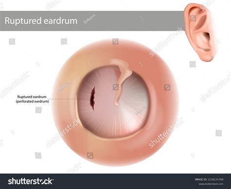 Ruptured Eardrum Bleeding EM@3AM: Tympanic Membrane Rupture EmDocs