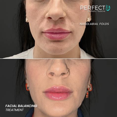 Facial BalancingTreatment Plan | Perfect B
