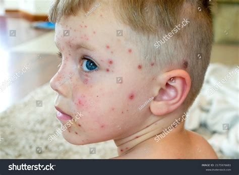 Measles Face