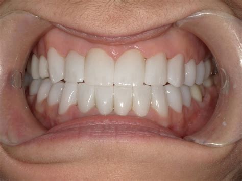 Gallery | Riverside, CA | Canyon Crest Dental