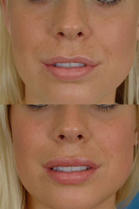 Lip Enhancement Before And After Photos at Jason Quinn blog