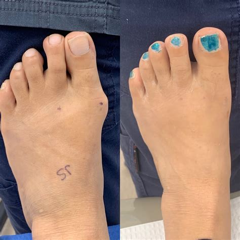 Foot Discoloration After Bunion Surgery at Colby Westlake blog