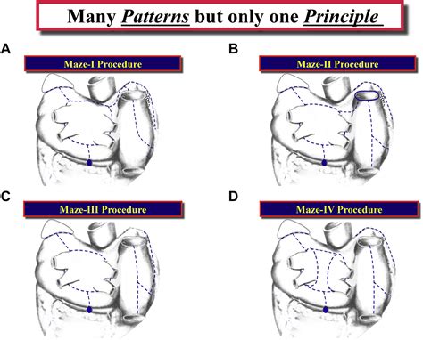 When Is a Maze Procedure a Maze Procedure? - Canadian Journal of Cardiology
