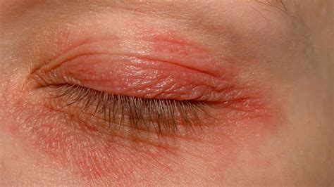 How to Get Rid of Red Under Eyes Effectively