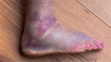 Minor Sprained Ankle