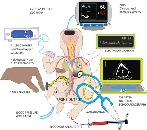Management of systemic hypotension in term infants with persistent ...