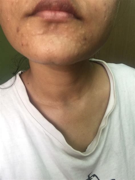 Itching Rash On Chin at Thomas Reiser blog